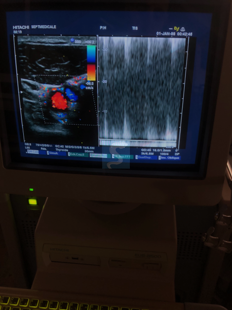 Echographe HITACHI EUB-8500 