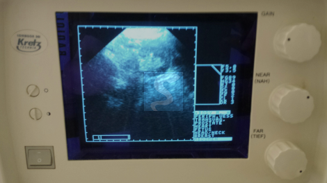 Echographe Kretz Combison 301 