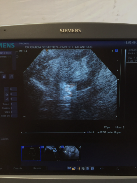 Siemens Acuson Antares V5.0  